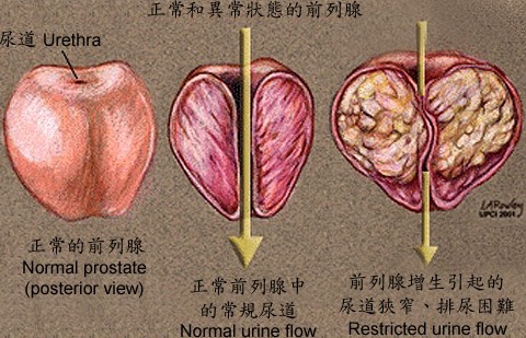 前列腺增生的前期征兆有哪些