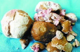 前列腺结石的治疗方法有哪些_陕西生殖医学医