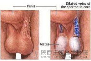 精索静脉曲张图片_手术费用_怎么治疗好?